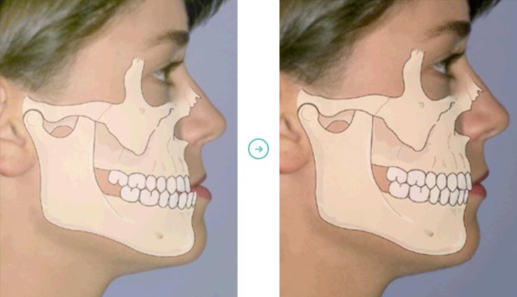 Homem Mandíbula Ou Maxilar Osso Com Dentes Em Três Quartos De